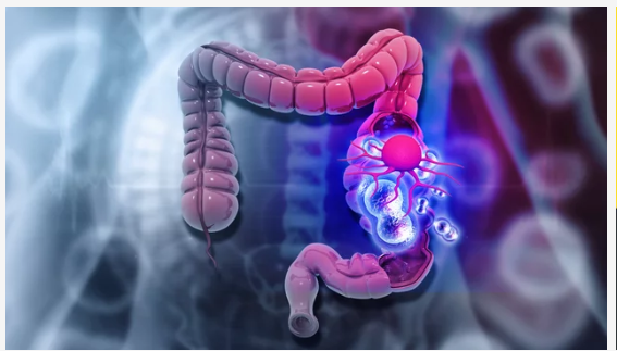 best colorectal cancer surgeon in Tardeo